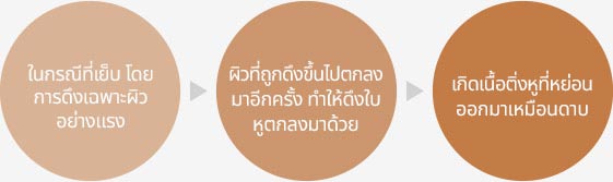 ในกรณีที่เย็บ โดยการดึงเฉพาะผิวอย่างแรง > ผิวที่ถูกดึงขึ้นไป ตกลงมาอีกครั้ง ทำให้ดึงใบหูตกลงมาด้วย > กิดเนื้อติ่งหูที่หย่อนออกมาเหมือนดาบ