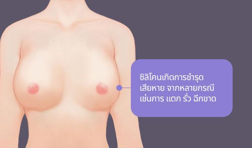 ซิลิโคนเกิดการชำรุด เสียหาย จากหลายกรณเช่นการ แตก รั่ว ฉีกขาด