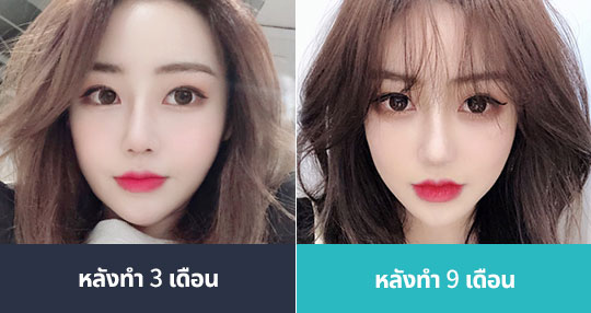 หลังทำ 3 เดือน -> หลังทำ 9 เดือน