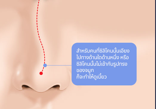 สำหรับคนที่ซิลิโคนนั้นเอียง
									ไปทางด้านใดด้านหนึ่ง หรือ
									ซิลิโคนนั้นไม่เข้ากับรูปทรงของจมูก
									ก็จะทำให้ดูเบี้ยว